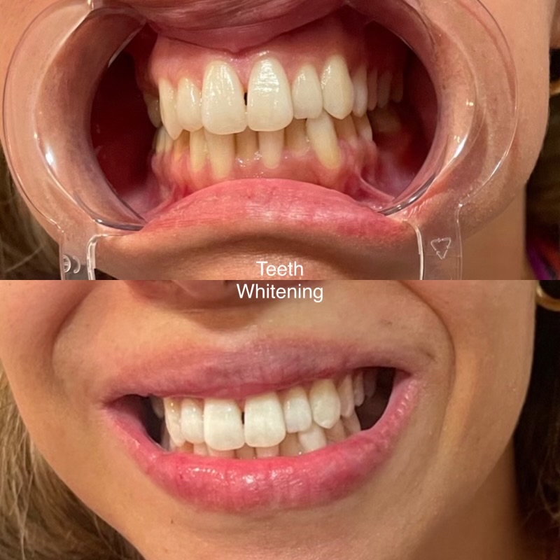 Teeth Whitening