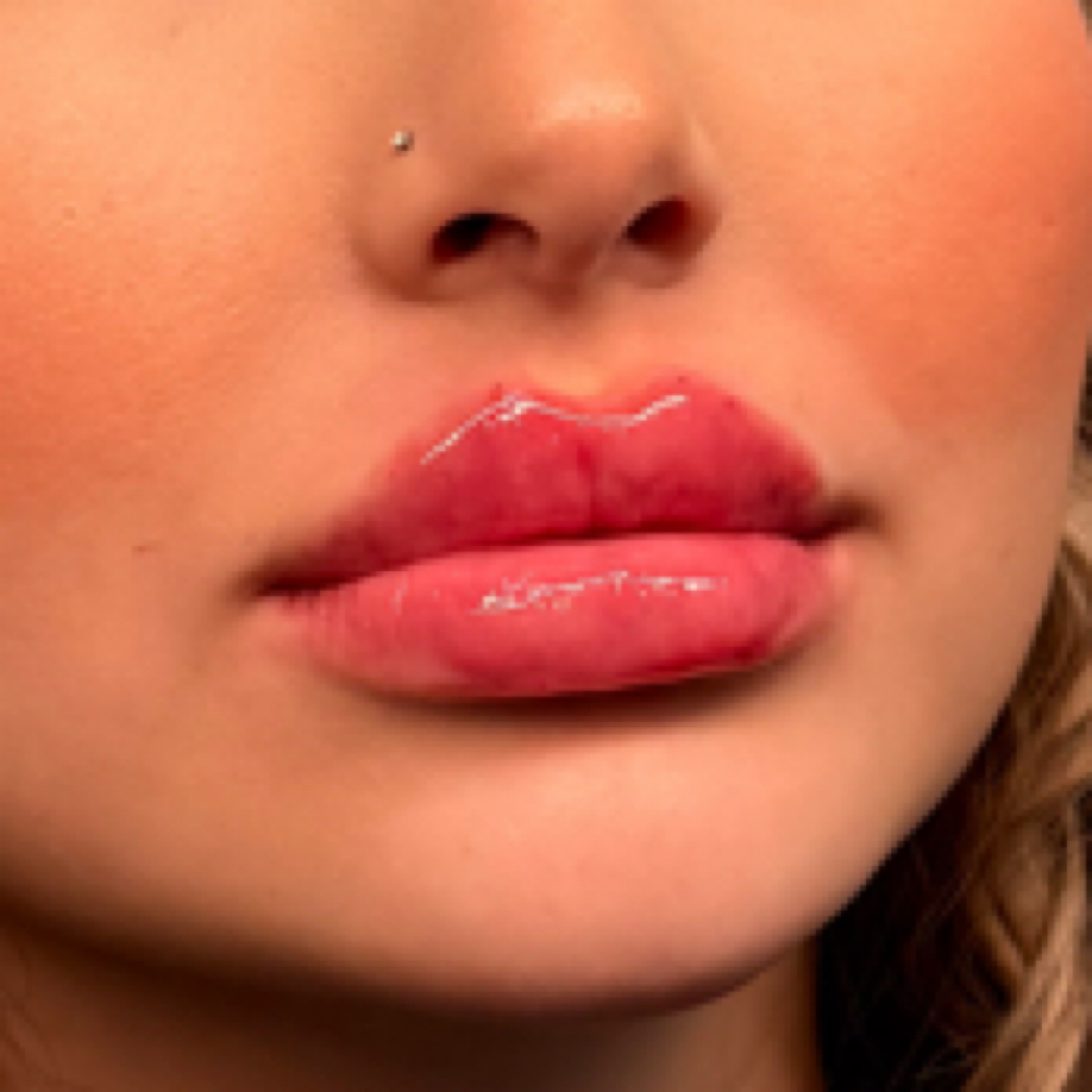 Lip Filler 0.5 ML at The Inkjectables Lab in El Paso, TX
