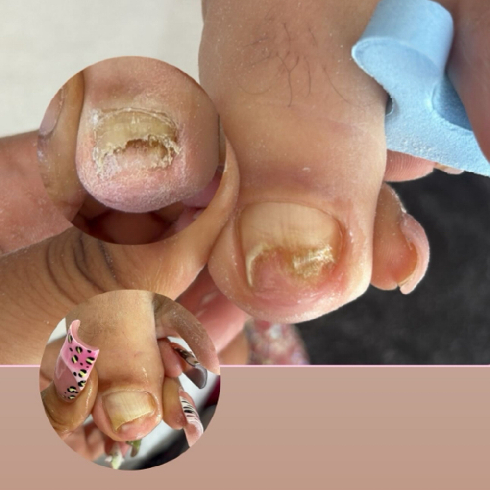 Mild Toe Fungus + Treatment at LuxBeautyLab in Kissimmee, FL