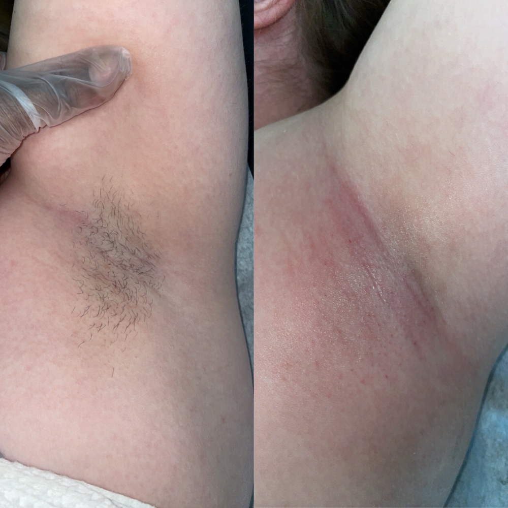 Armpit Wax at Elation Esthetics in Lubbock, TX