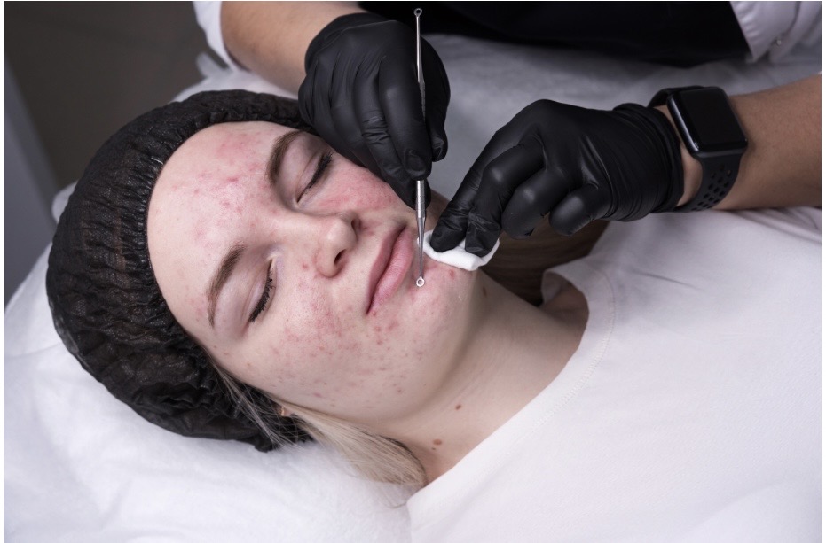 Acne-fighting facial