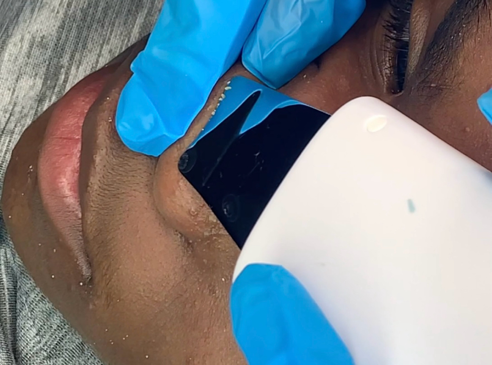 Acne Facial ($70)
