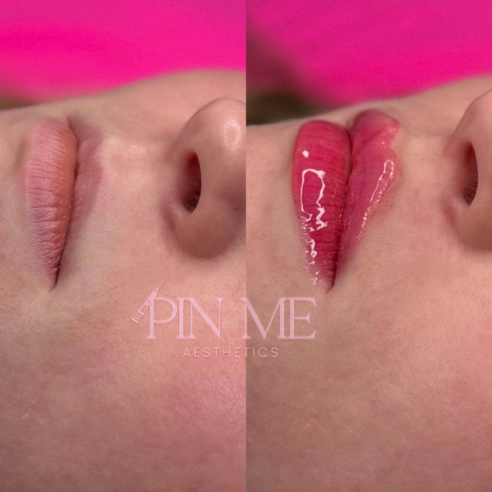 1/2 Syringe Of Lip Filler at Pin Me Aesthetics PLLC in Alvin, TX