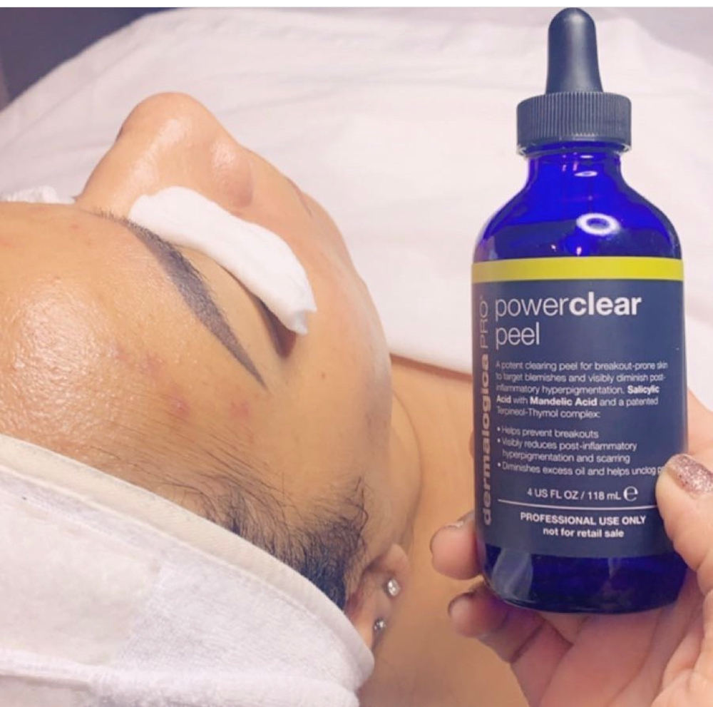 Chemical Peel