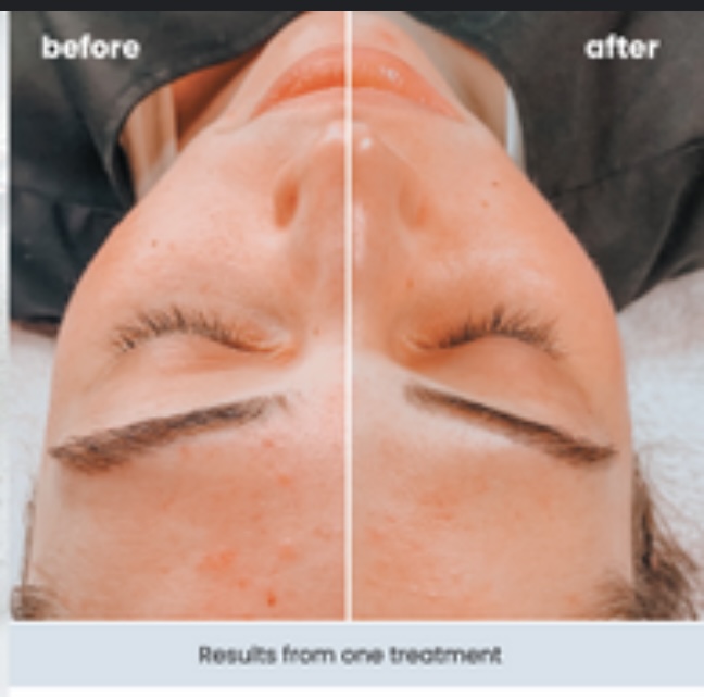 Oxygen Rx Facial