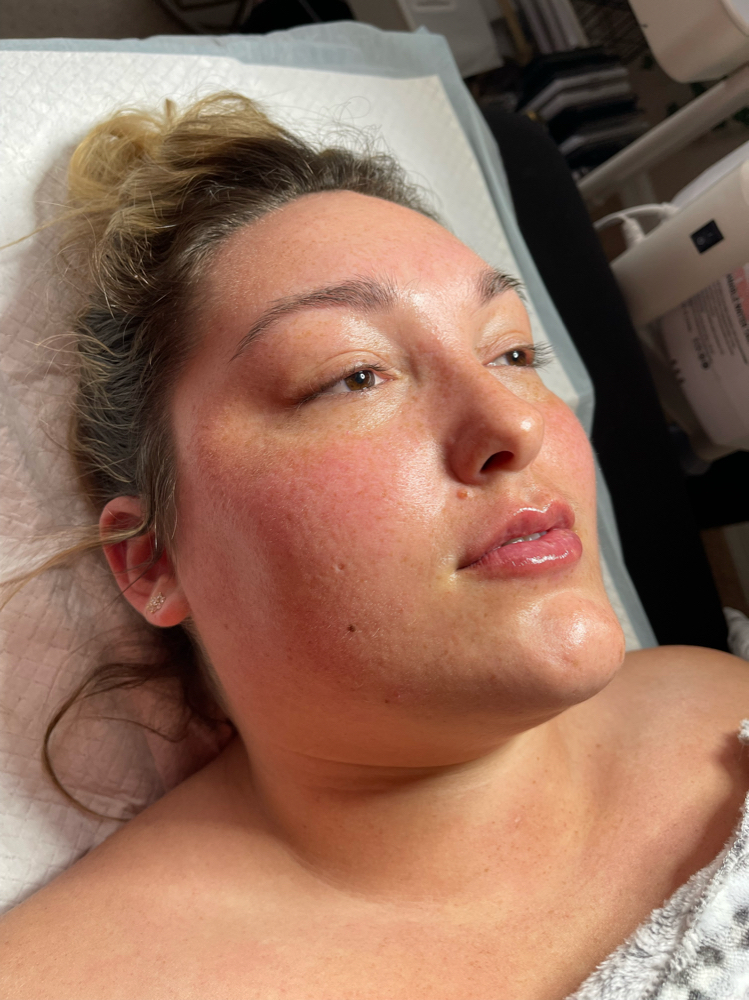 Dermaplaning Facial