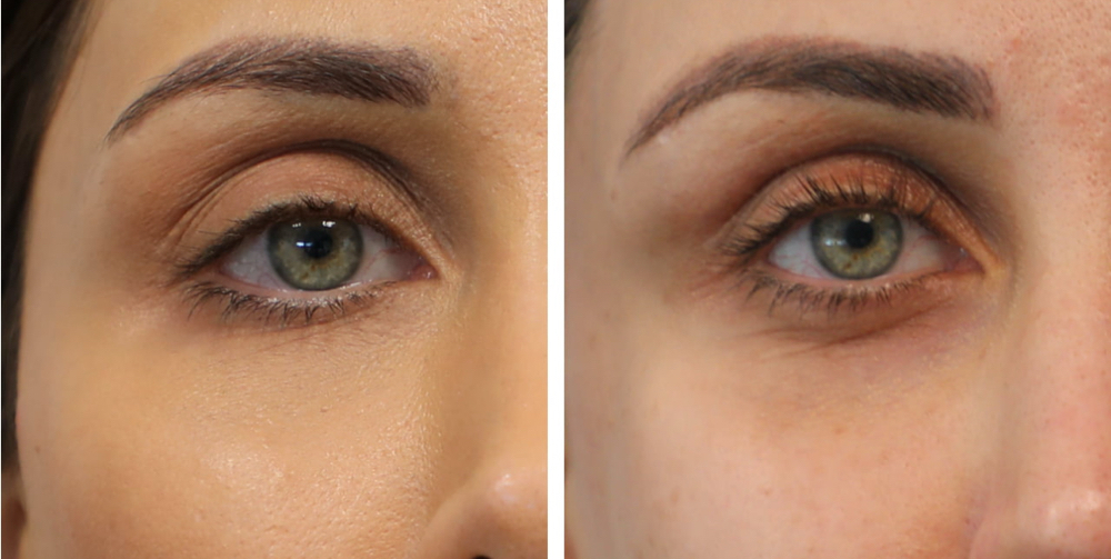 Dermal Filler Dissolver