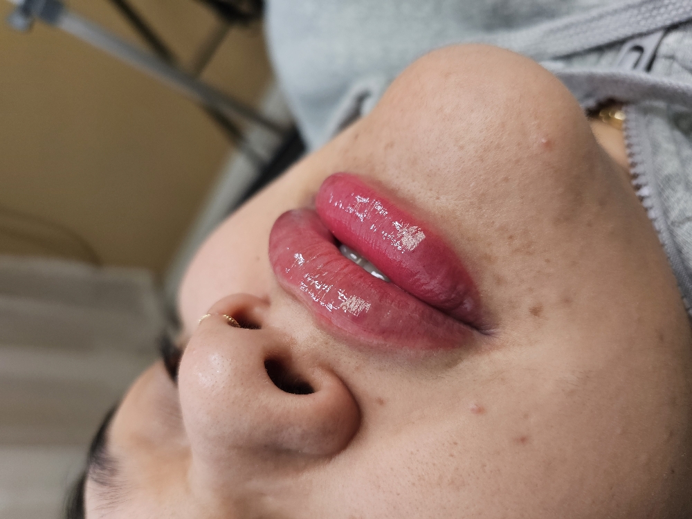 HA Lip Filler 1-6 Months TouchUp