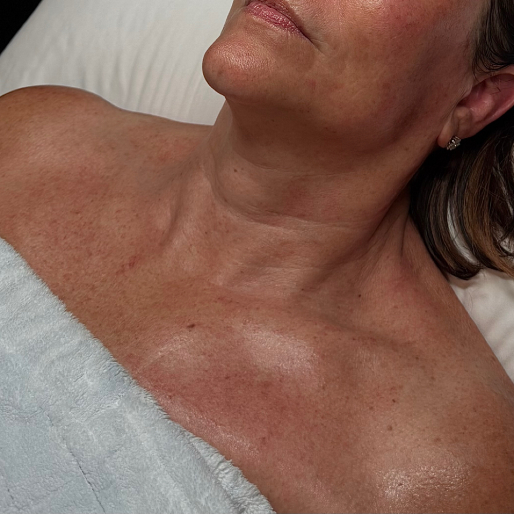 Microneedling Décolleté Add-On at SKIN BY HAYLEE in Rochester, MN