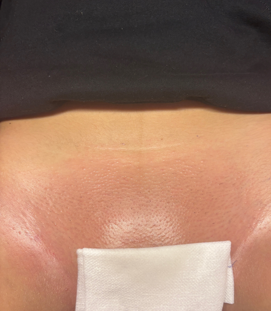 Brazilian Wax- Returning