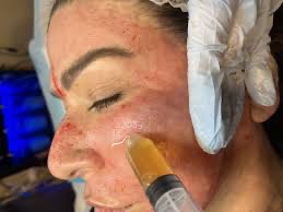 Microneedling w/PRP