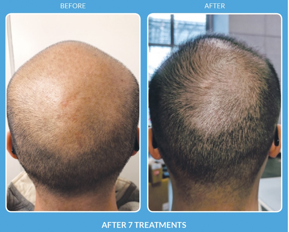 Hair Restoration (Full Scalp)