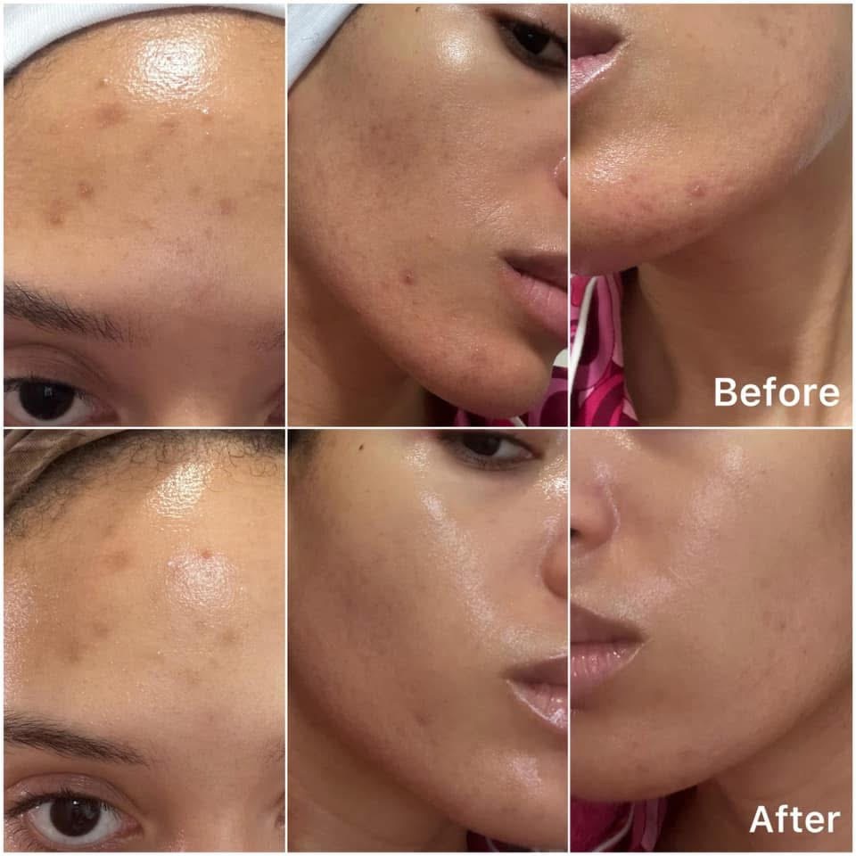 Radiance Renewal Brightening Facial at C. Walker Skin Company in Cookeville, TN