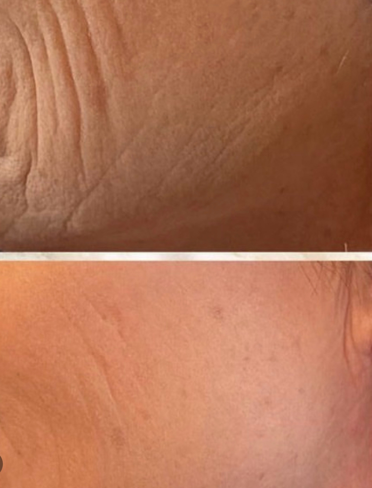 Anti-Aging Peel