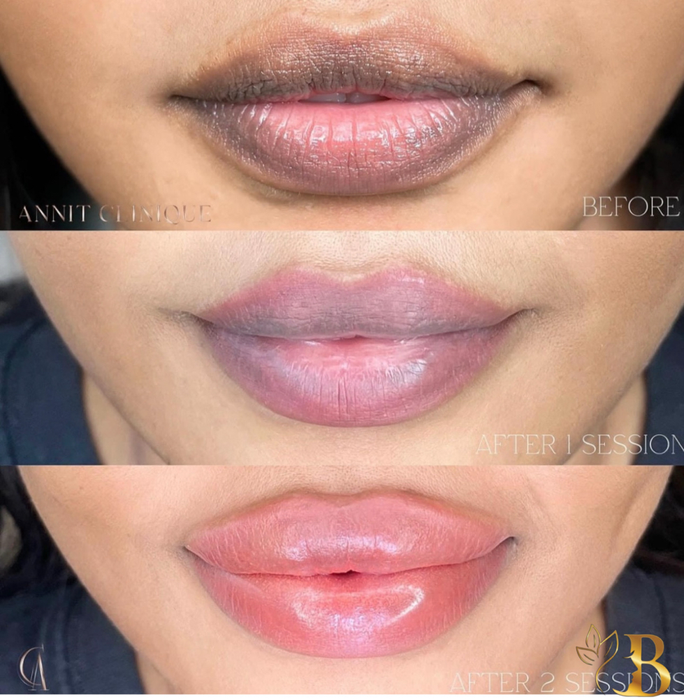 Lip neutralization-$380