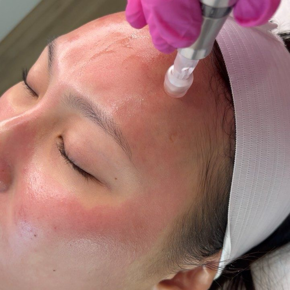 Microneedling