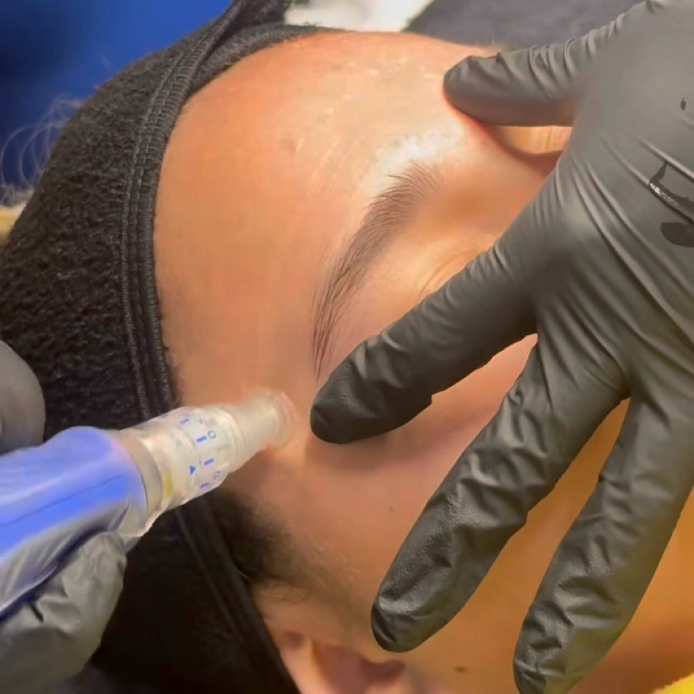 Microneedling at Beautyy by Madison in madisonville, KY