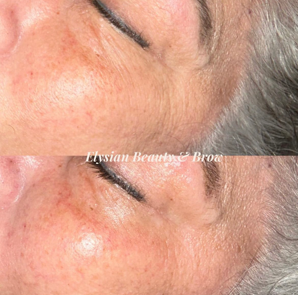 Nano Facial