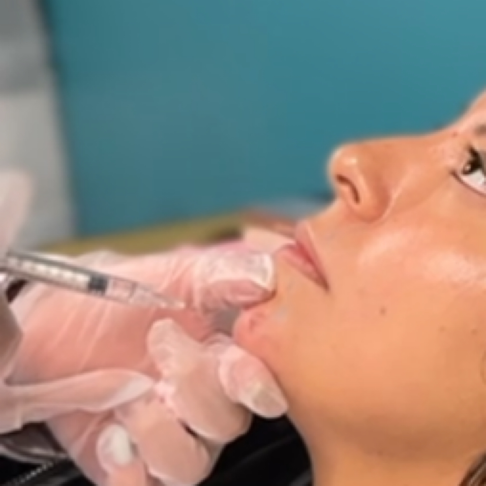 Chin Filler at Latina Body Contour Spa in Dallas, TX