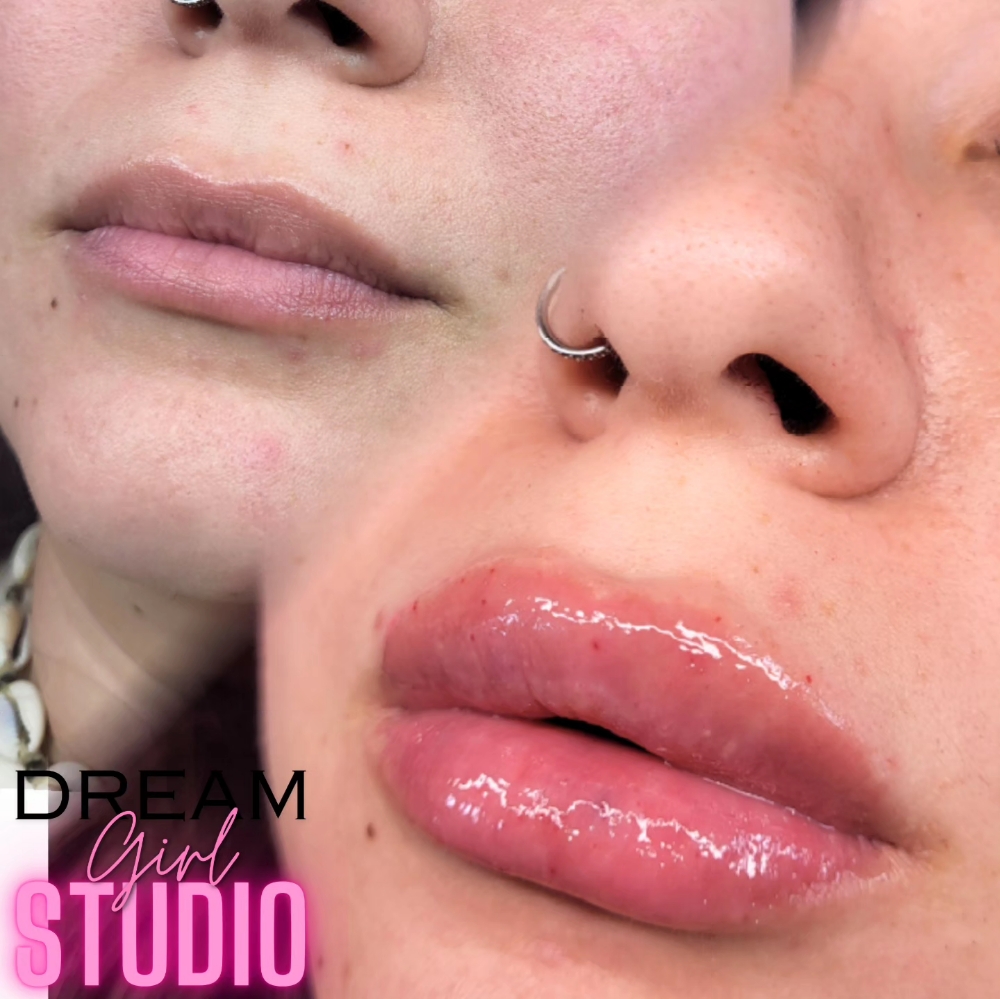 3ML Lip Filler