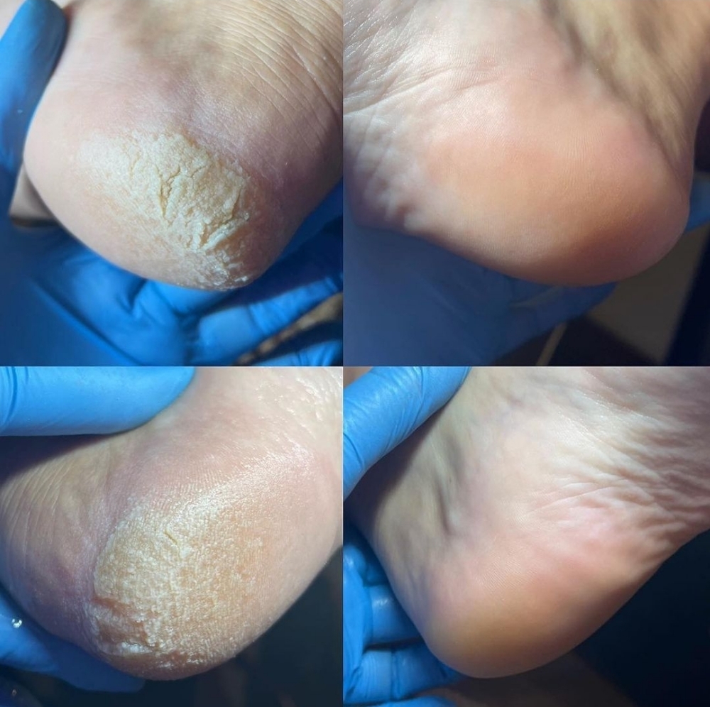 Chemical Foot Peel Addon