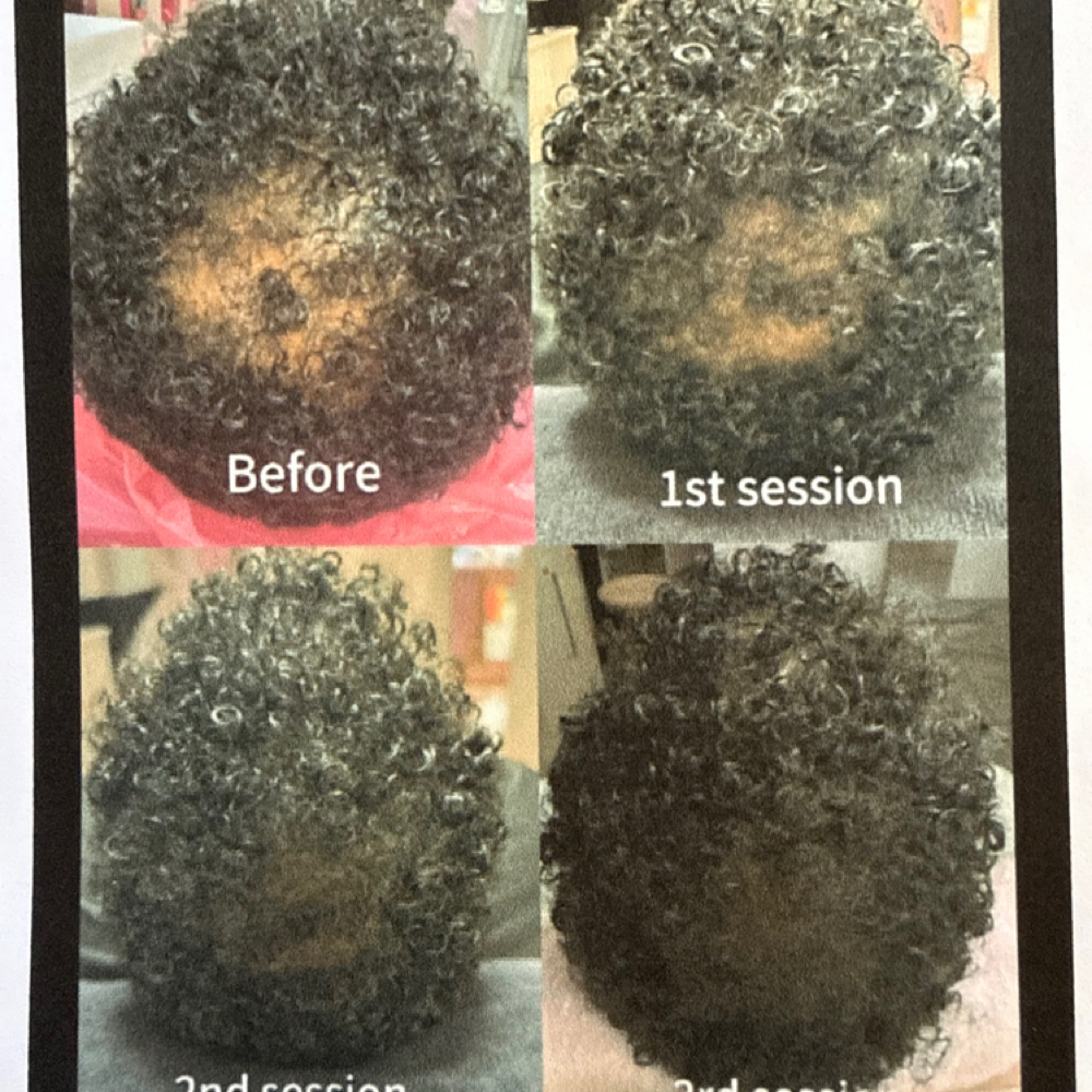 Hair Density at Body Contouring & More in Modesto, CA