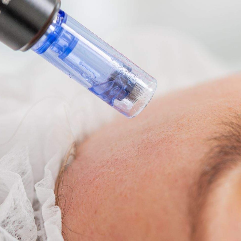 Microneedling at Aesthetica Organic Spa in Houston, TX