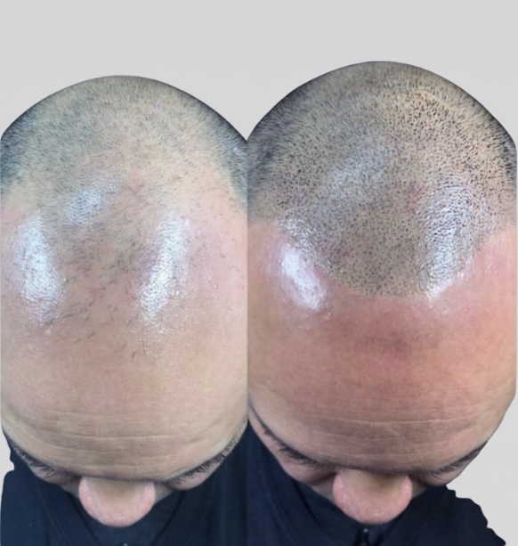 Scalp Micropigmentation at Bella Made Beauty Studio in Henderson, NV
