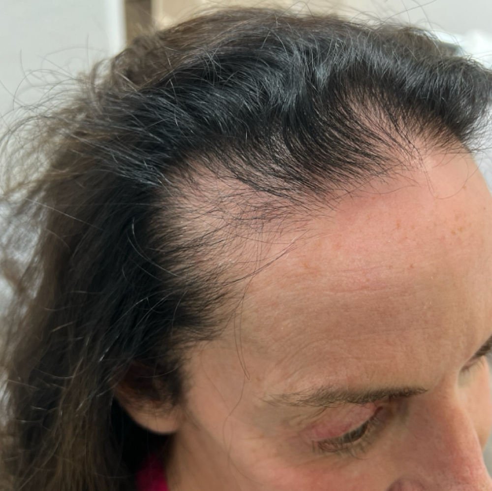 Scalp Micropigmentation Consultation at The Bar Aesthetics in Pinole, CA