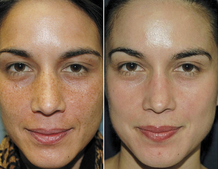 Image Perfection Peel