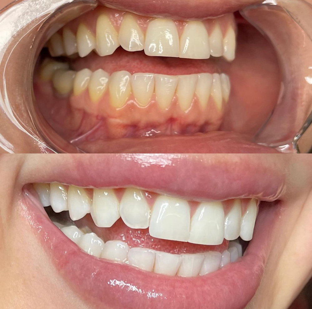 Teeth Whitening (1 Hr)