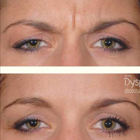 Dysport ( 90units ) at EVERWELL LUXE in Kissimmee, FL