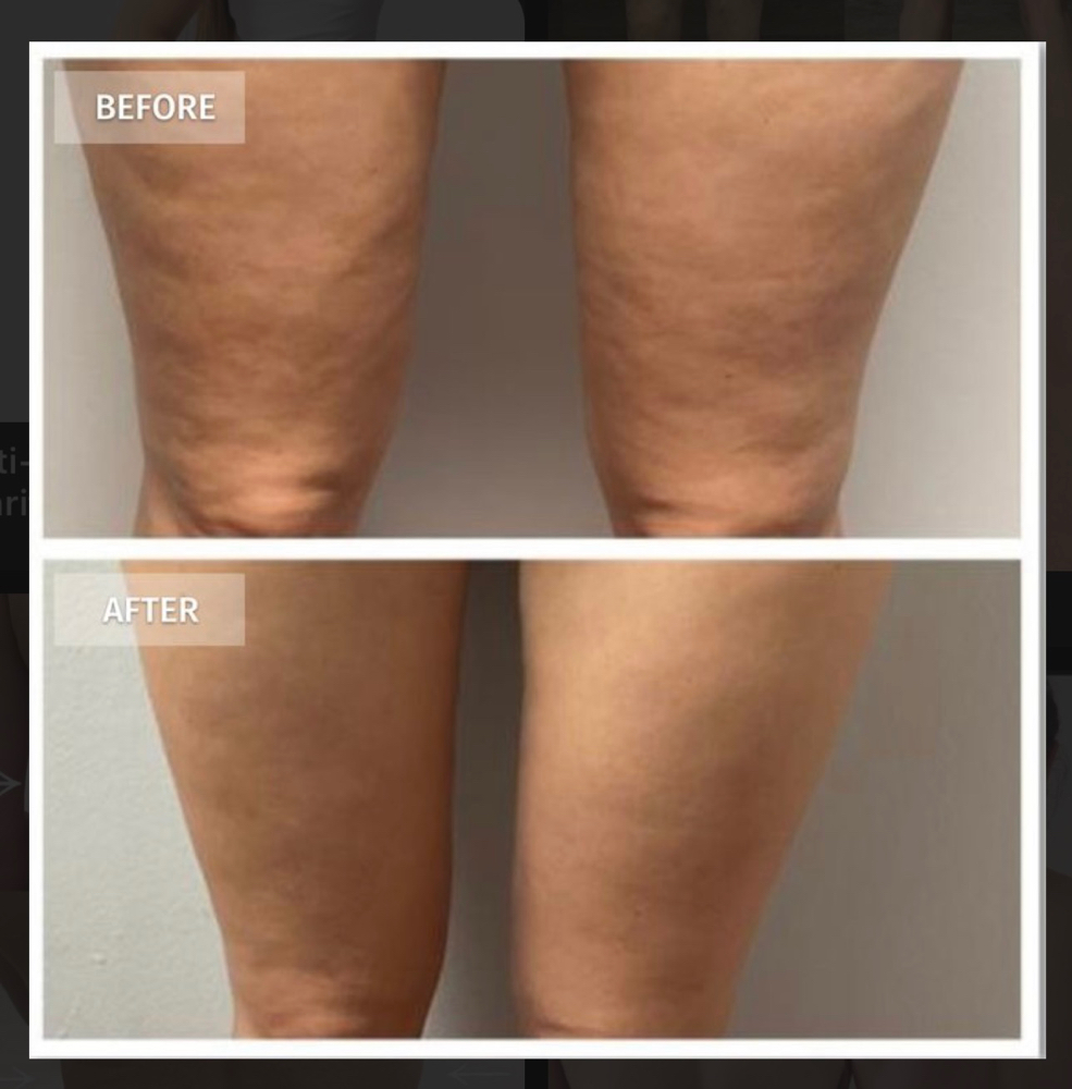 Cellulite Removal