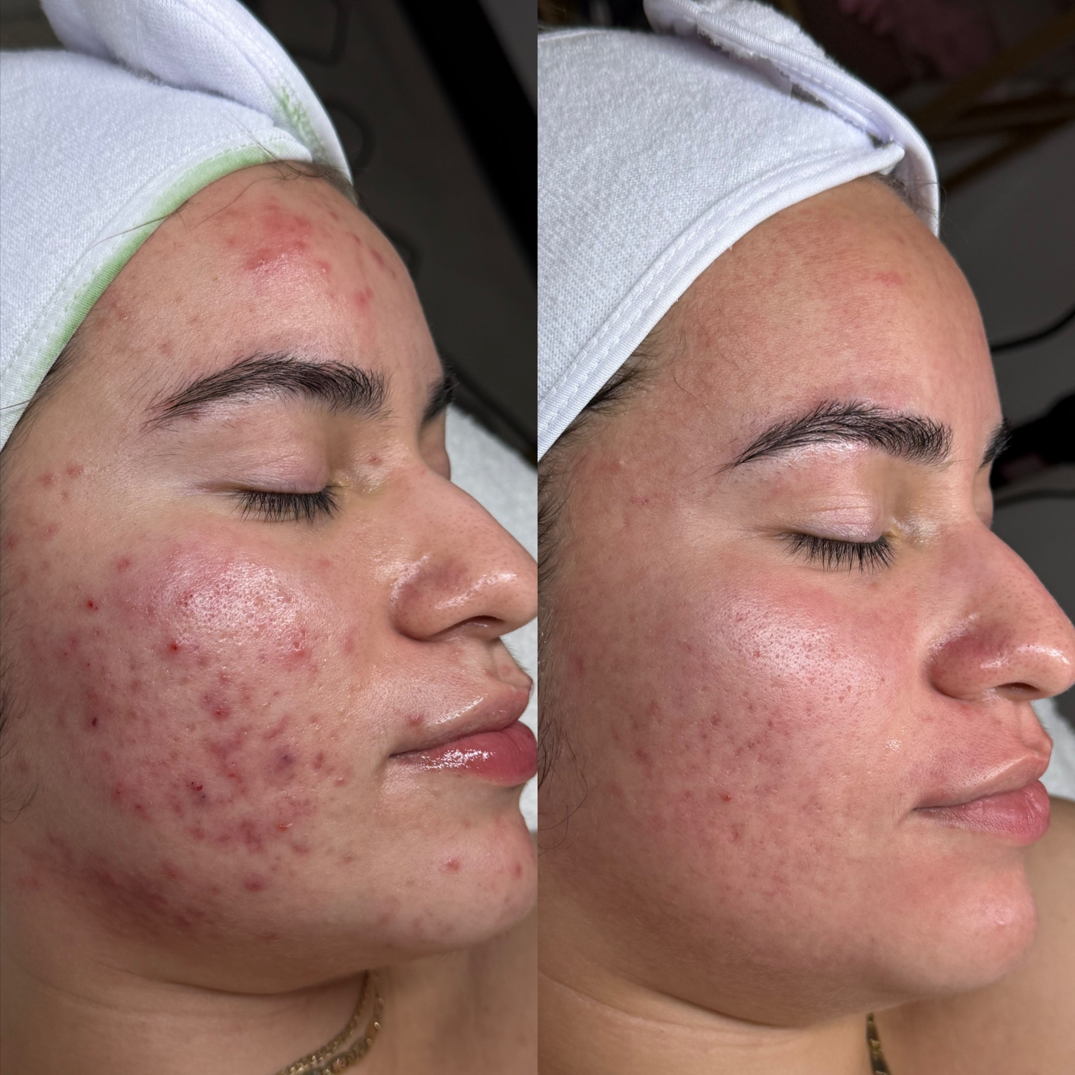 Clear Skin Program Acne Peel at Ruby Williams Aesthetics LLC in Sarasota, FL