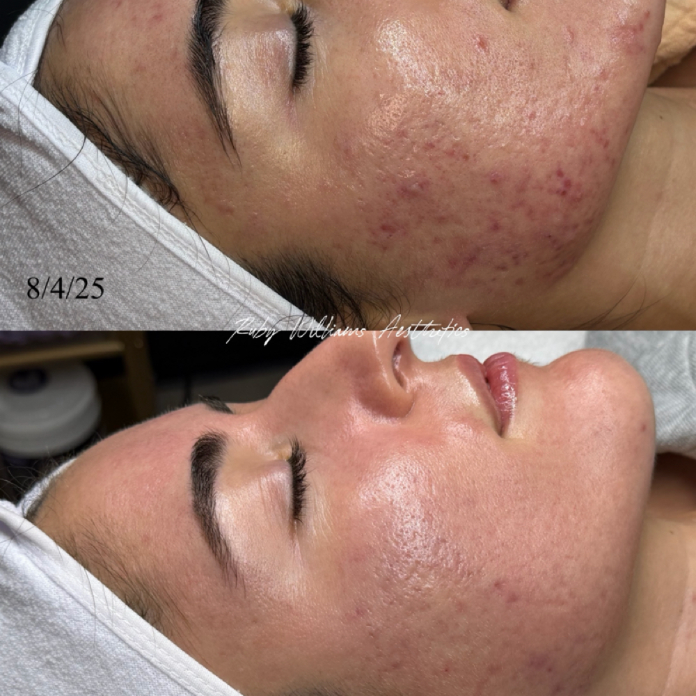 Bi-weekly Clear Skin Facial at Ruby Williams Aesthetics LLC in Sarasota, FL