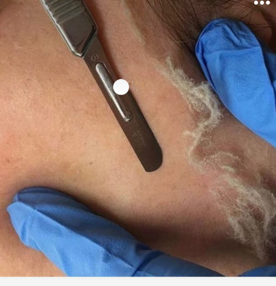Dermaplane