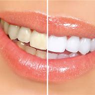 Advanced Teeth Whitening