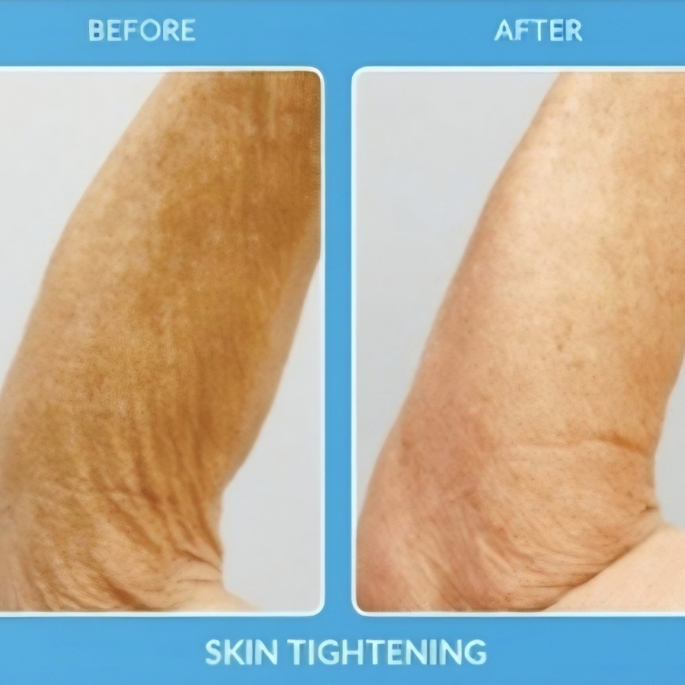 2 Skin Tightening Bundle Of 2