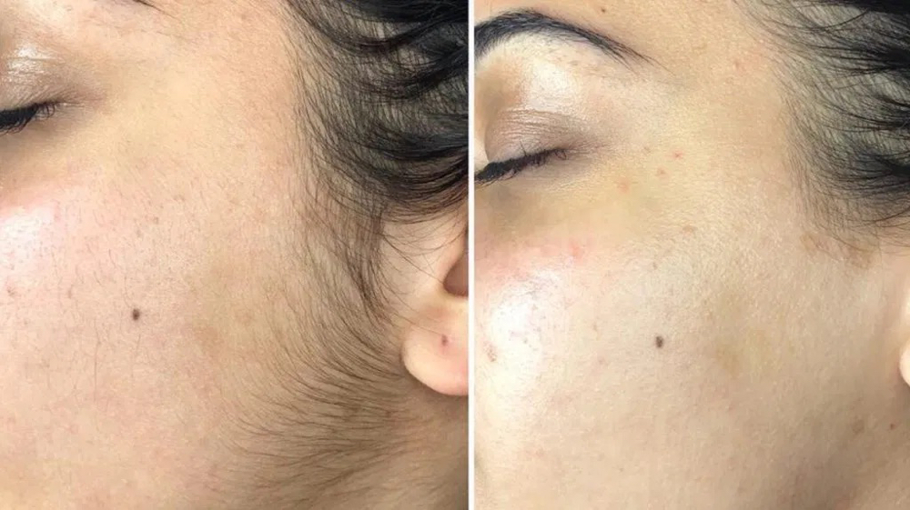 Dermaplane Facial