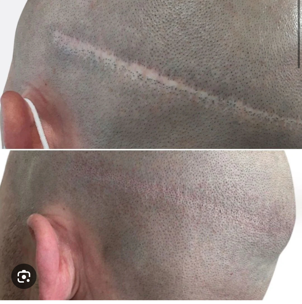 SMP Hair Transplant Scar