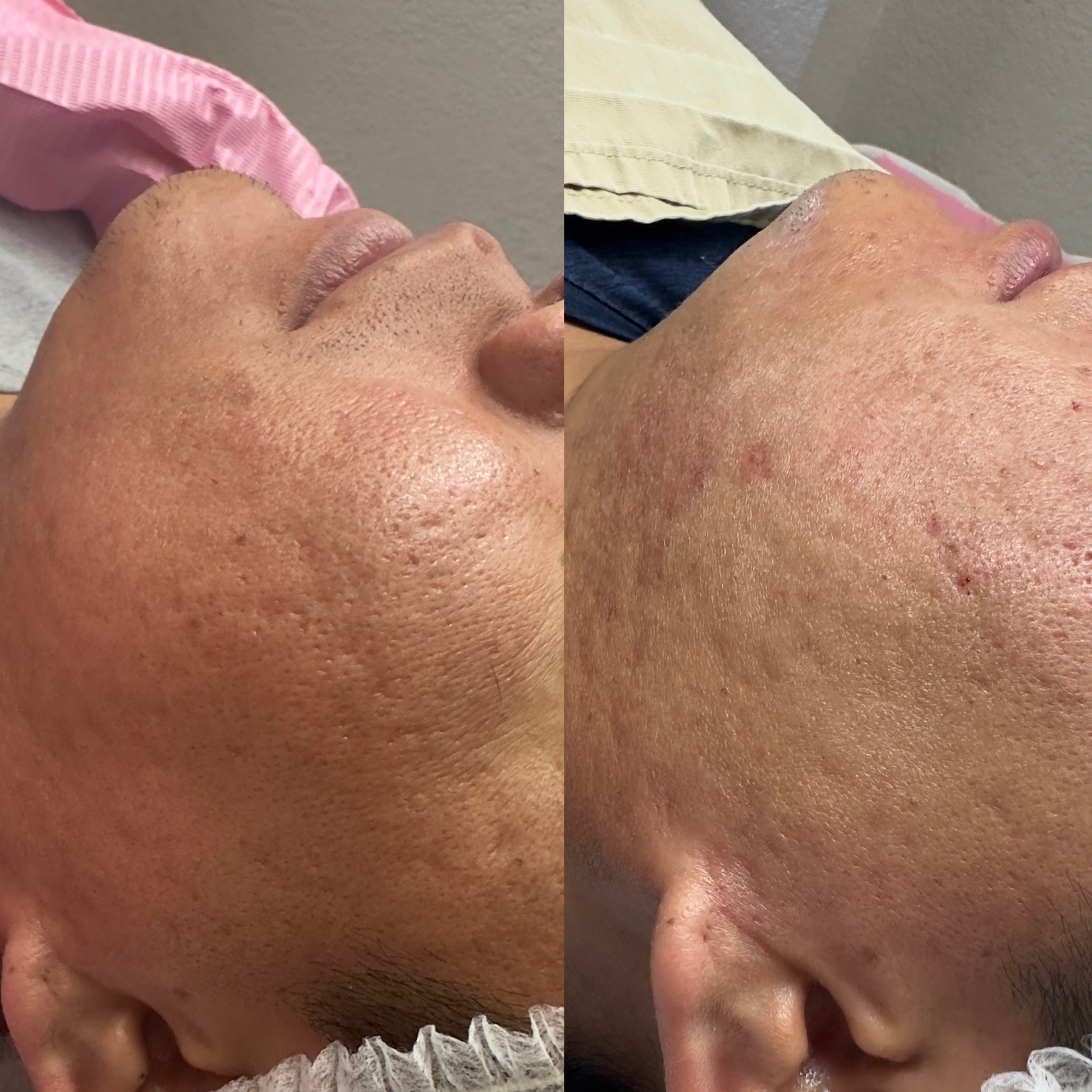 Acne scars Treatment at Mahelia PMU Academy in Whittier., CA