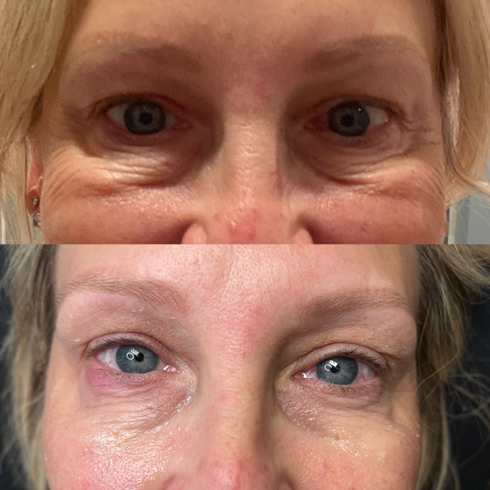 Undereye / Tear Trough Filler