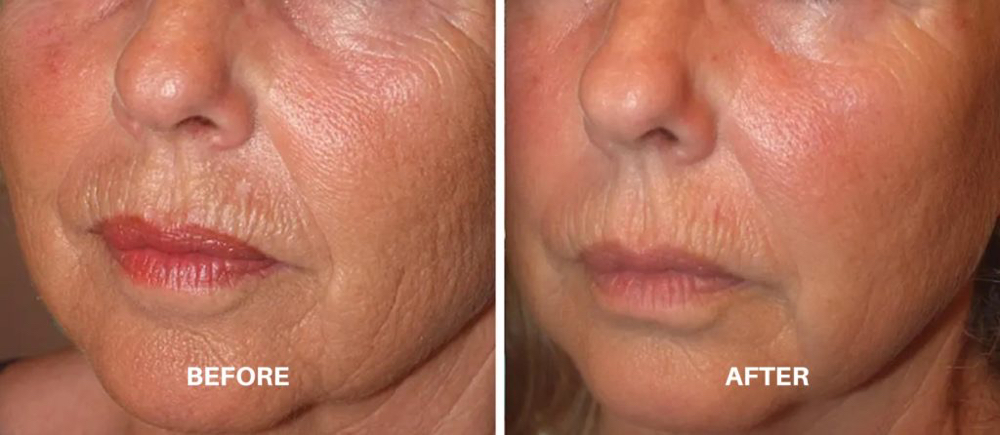 Radio Frequency Facial Skin Tighten