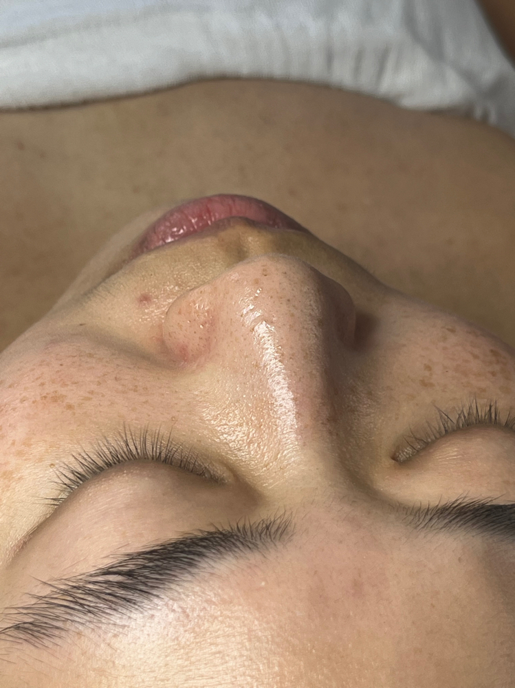 These Blackheads at Ethereal Skin x Jenn in Bloomfield, NJ