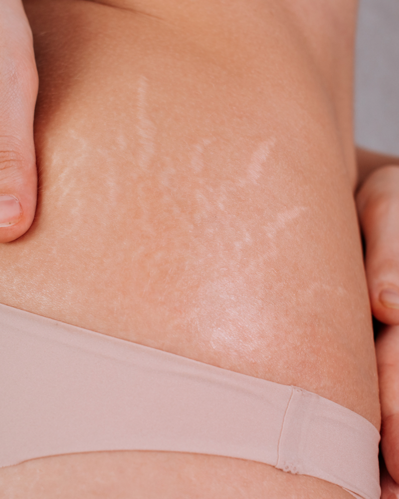 Inkless Stretch Mark Rejuvination