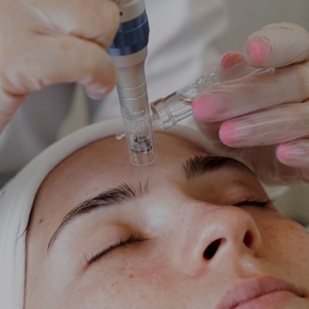 Nanoneedling Infusion at Sancorsthetics in Riverside, CA