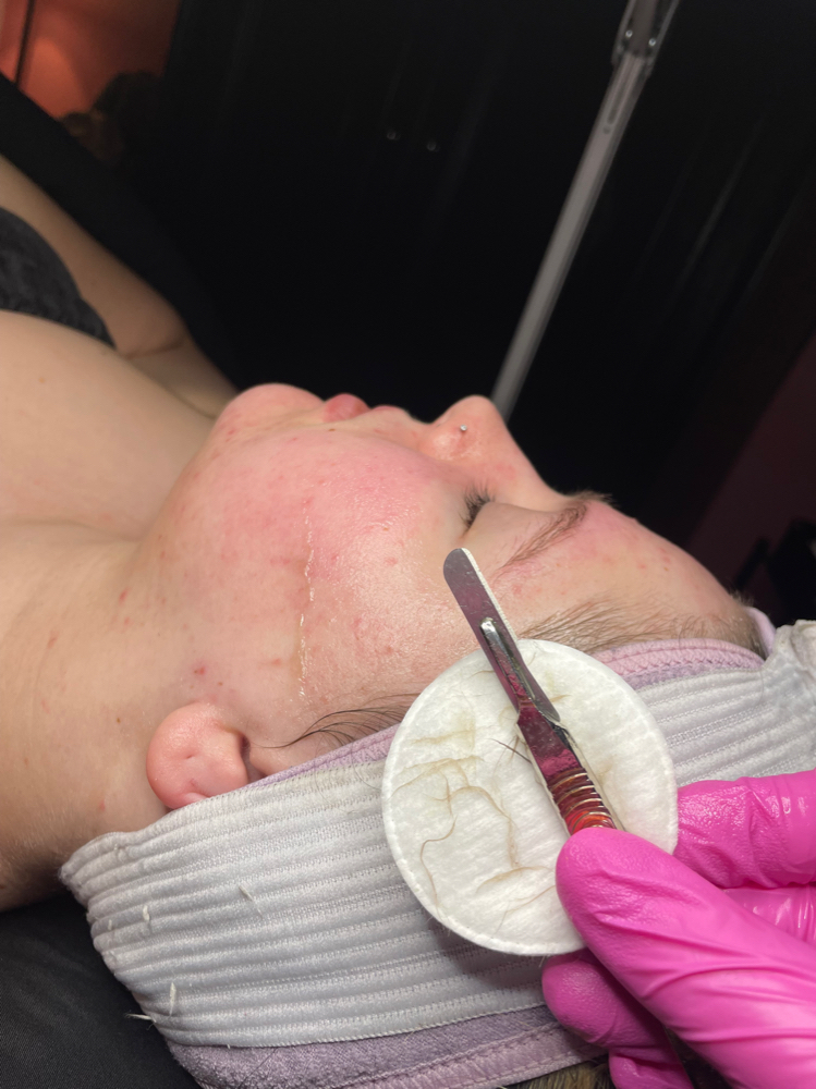 Dermaplaning Facial