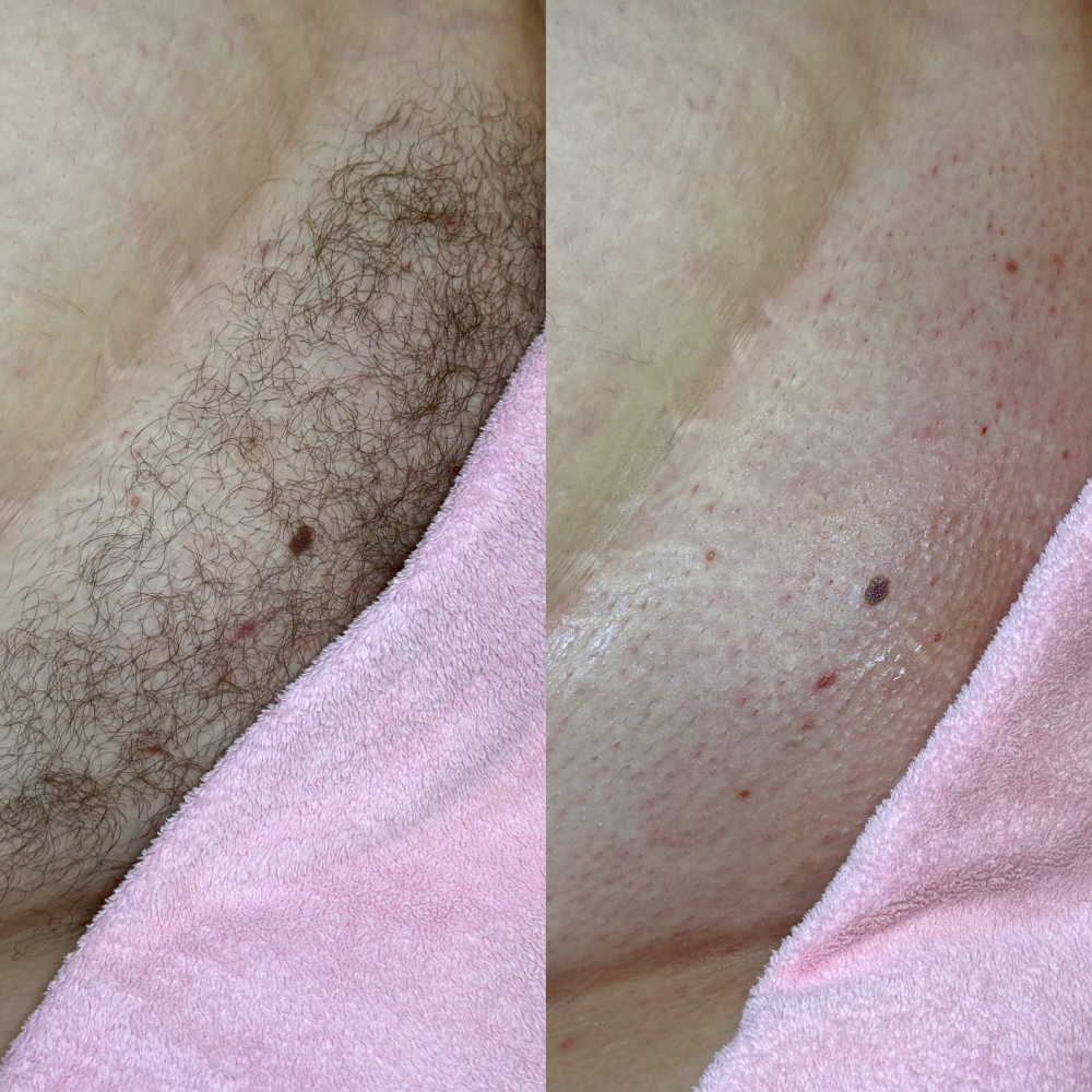 Brazilian Wax + Bundles at Bare Beauty Esthetics in Springfield, TN