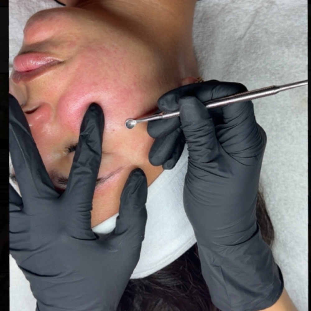 Add On Exfoliation W/ Extractions P at Angel Aesthetics in Jacksonville, FL