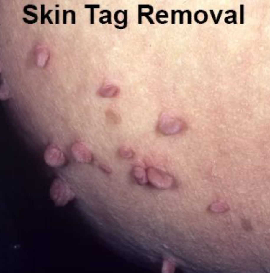 Skintag Removal